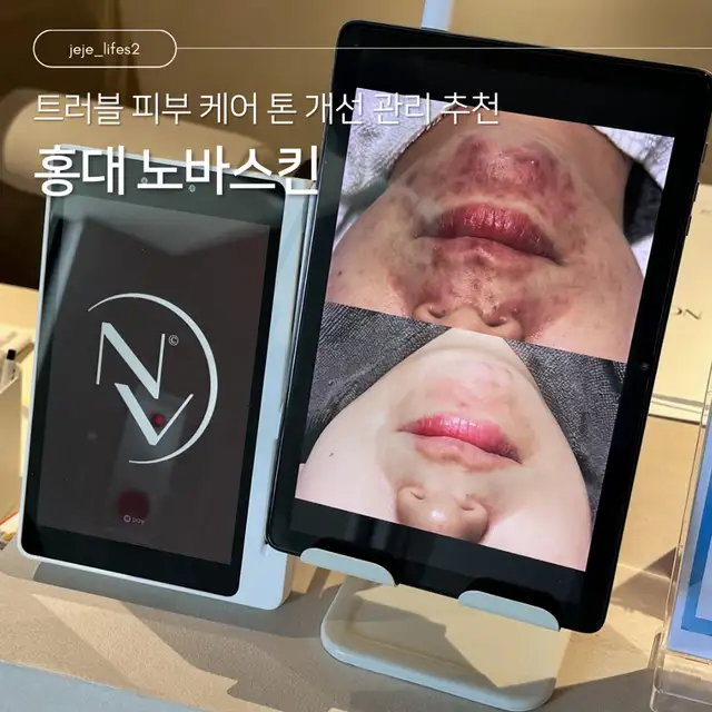 노바스킨 사진 7
