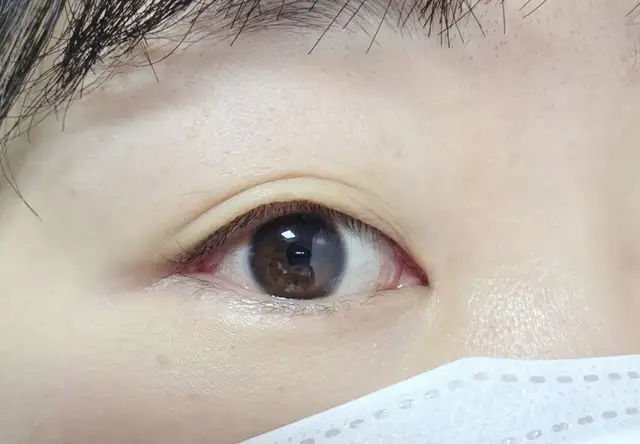 말랑래쉬 사진 5